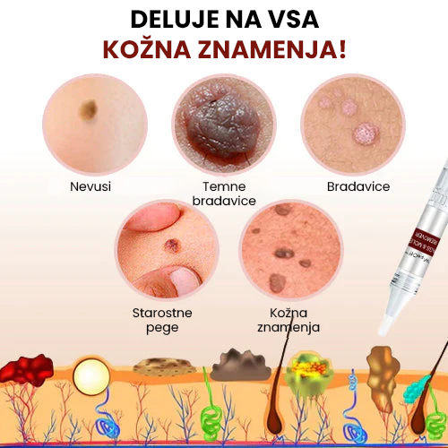 Krema Pen za odstranjevanje mravelj, znamenj in kožnih bradavic!