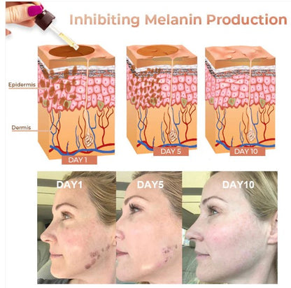 Obrazni serum za hitro odstranjevanje temnih madežev za korekcijo melanina
