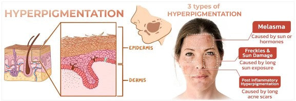 Obrazni serum za hitro odstranjevanje temnih madežev za korekcijo melanina